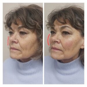 , Lip and Dermal Fillers