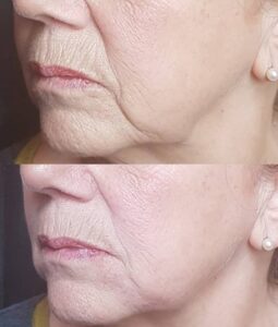 , Lip and Dermal Fillers